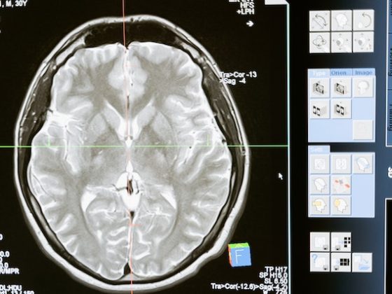 brain scan photo