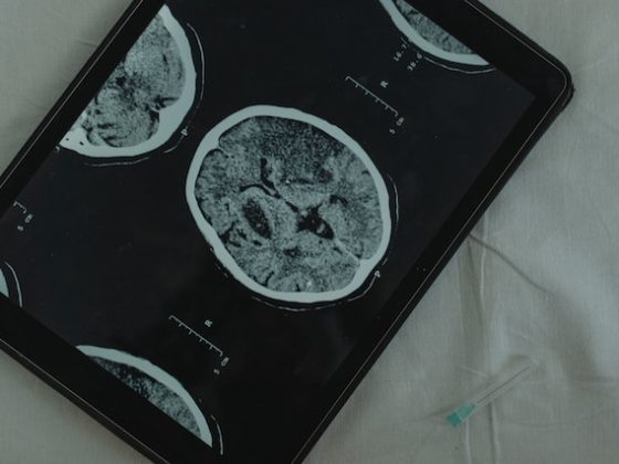 brain scan displayed on an ipad