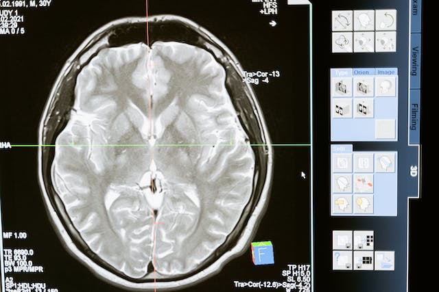 brain-scan-for-gamma-light-alzheimer